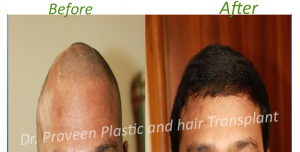 b1 hairtransplant