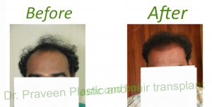 hair restoration final