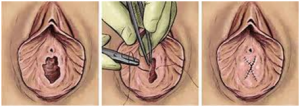 hymenoplasty